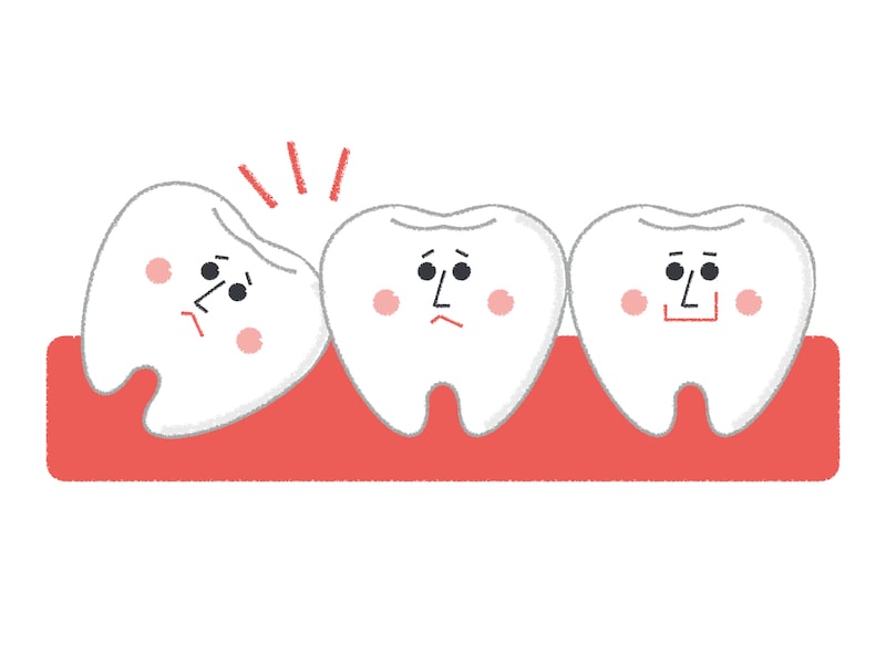 親知らずの抜歯