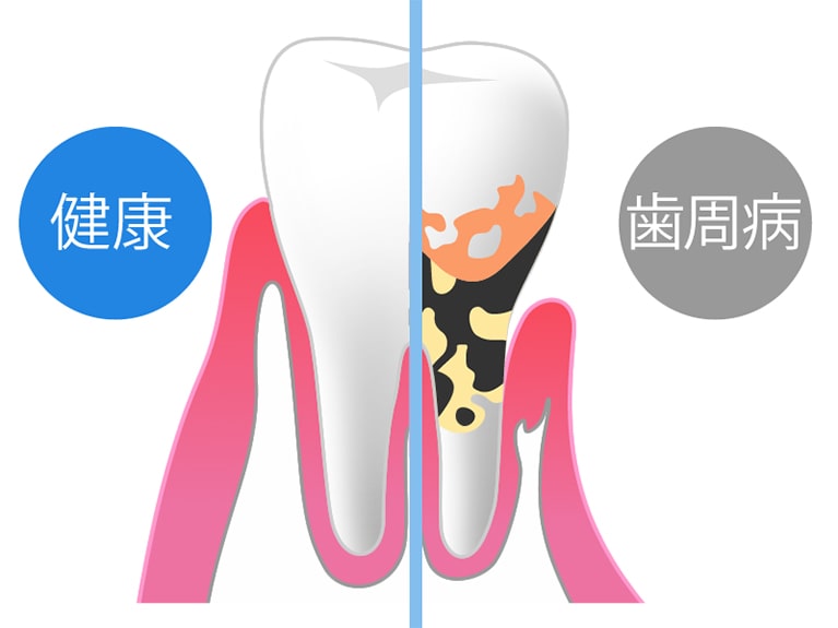 初期症状がほとんどないまま進行する怖い病気です